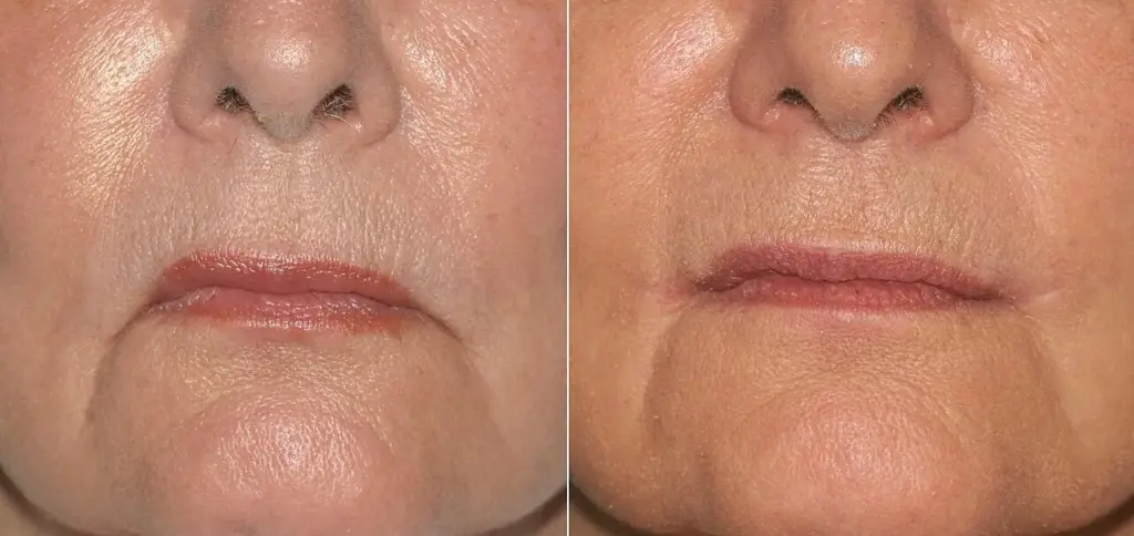 Lip-Lift e collane di Venere: i ritocchi estetici che Belén Rodriguez sceglie per ringiovanire
