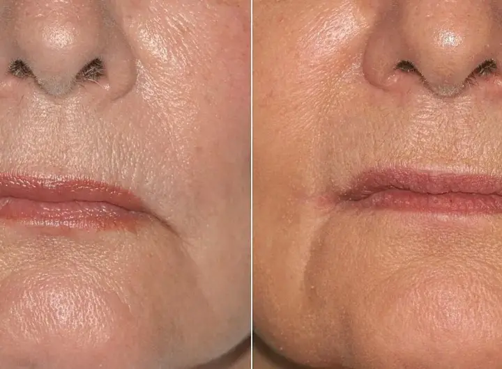 Lip-Lift e collane di Venere: i ritocchi estetici che Belén Rodriguez sceglie per ringiovanire