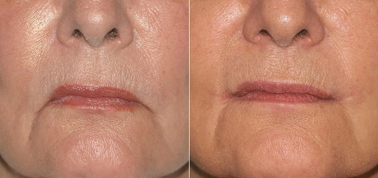 Lip-Lift e collane di Venere: i ritocchi estetici che Belén Rodriguez sceglie per ringiovanire